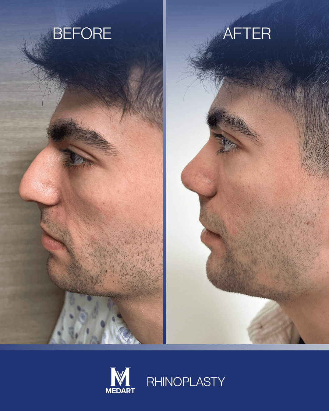 Before After transformation 4